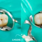 Dental Fillings in Yenibosna: A Practical Guide