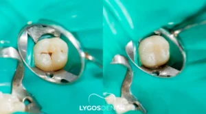 Dental Fillings in Yenibosna: A Practical Guide