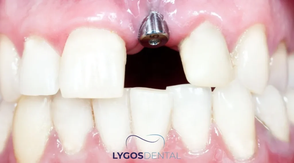 Dental Implants in Bakırköy: What to Know