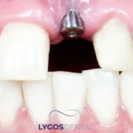 Dental Implants in Bakırköy: What to Know