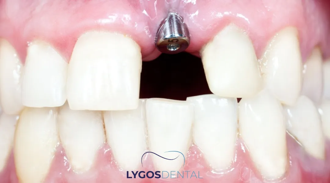 Dental Implants in Bakırköy: What to Know