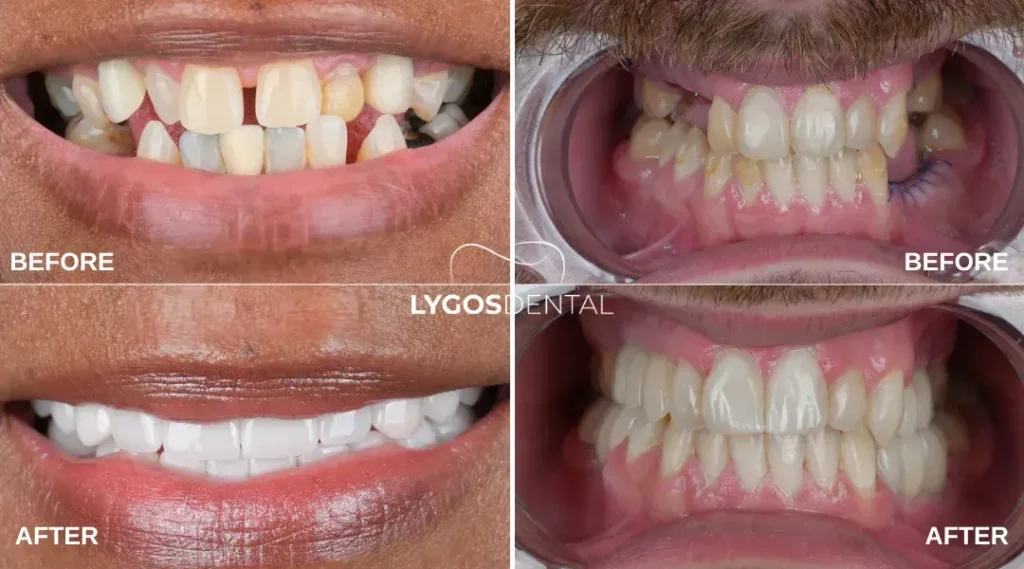 Impianti dentali a Istanbul