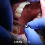 Impianti dentali a Istanbul