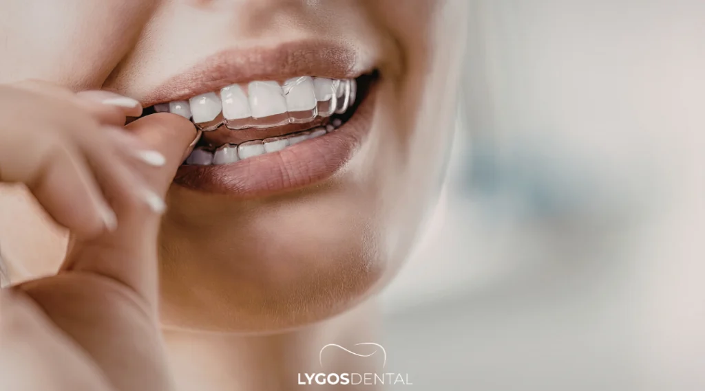 Clear Aligner Treatment in Istanbul