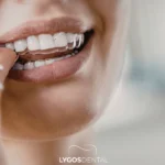 Trattamento con allineatori trasparenti a Istanbul