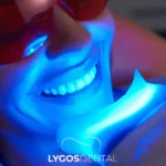 Sbiancamento dei denti a Istanbul: prezzi, metodi e cosa cercare in una clinica