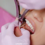 Özelde Diş Çekimi Fiyatı Ne Kadar?