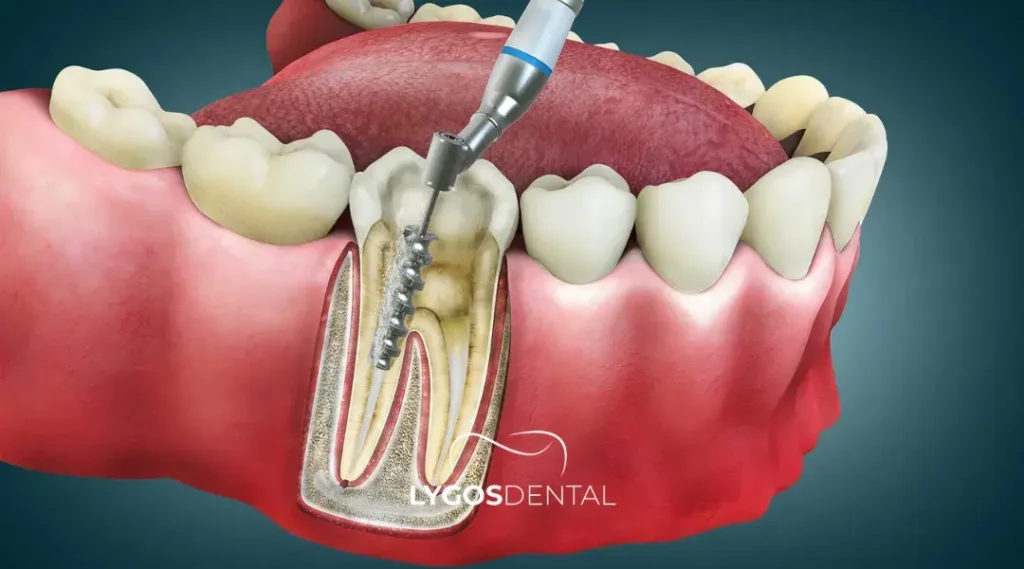 Root Canal Treatment in Istanbul