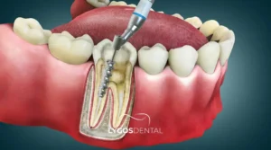 Root Canal Treatment in Istanbul