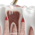Root Canal Treatment in Yenibosna: A Clear Guide