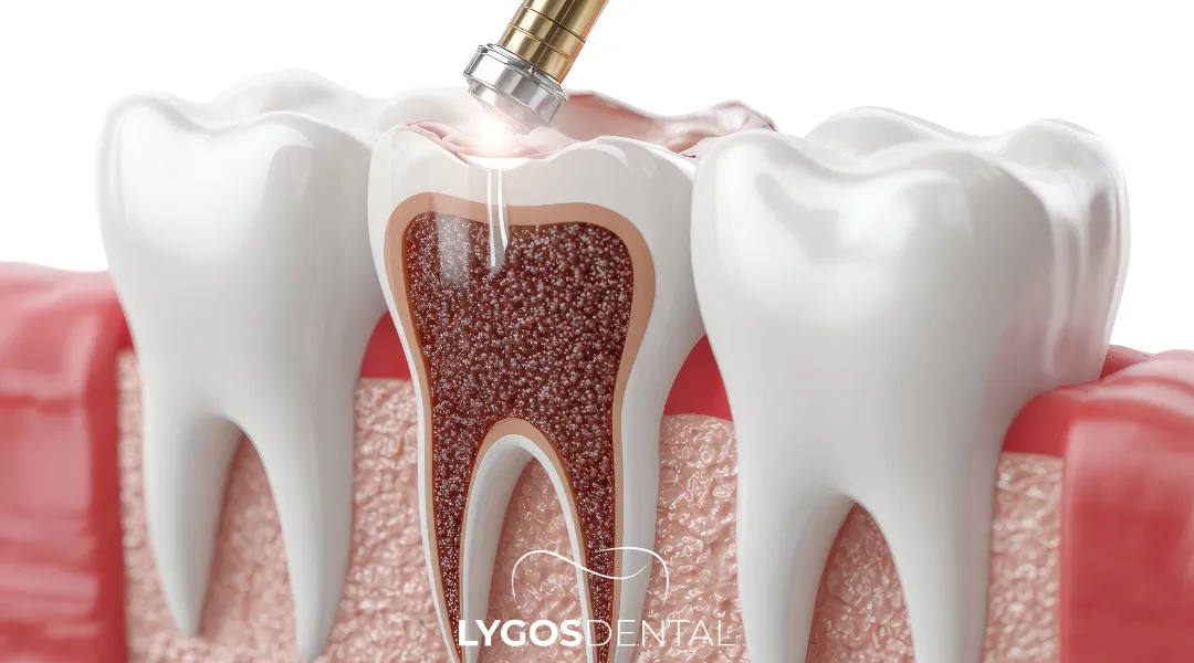Root Canal Treatment in Yenibosna: A Clear Guide
