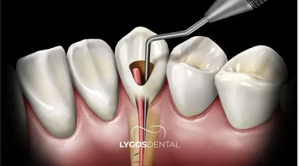 Trattamento canalare a Istanbul