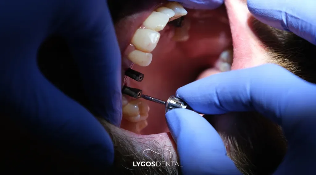 Single Implant vs Full-Mouth Treatment
