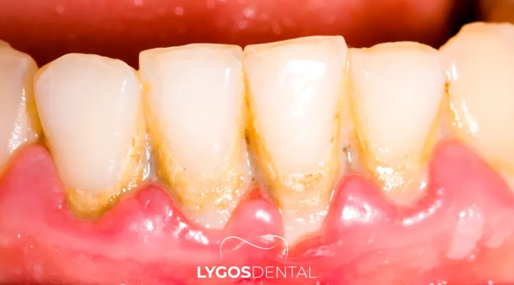 Tartar Cleaning in Yenibosna: A Practical Guide