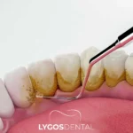 Tartar Cleaning in Yenibosna: A Practical Guide