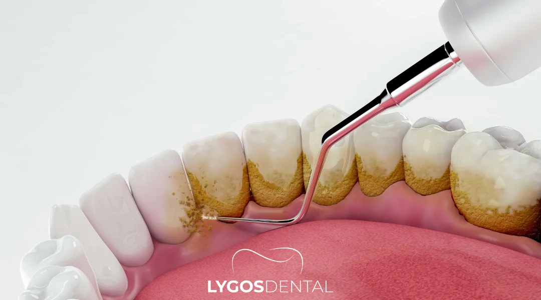 Tartar Cleaning in Yenibosna: A Practical Guide