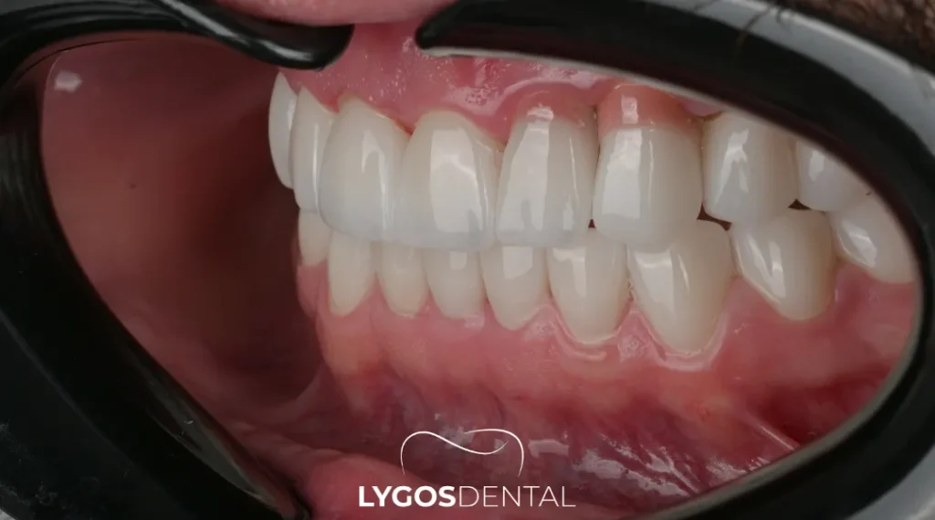 Zirconium Crowns in Yenibosna