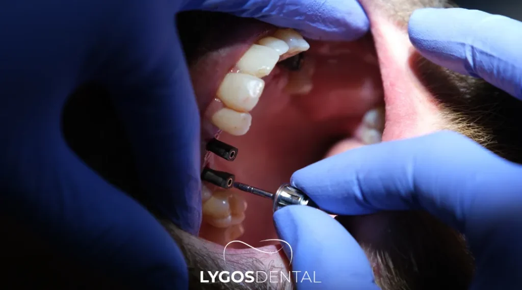 Budapest Dental Implant Prices 1 What a Budapest quote usually covers