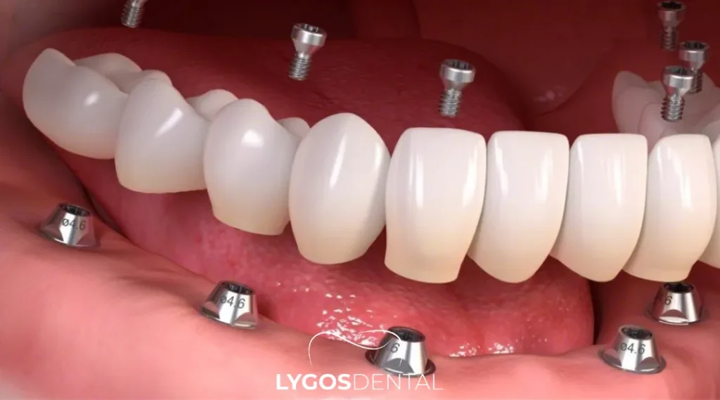 Full Mouth Implants Dublin Cost: What to Expect