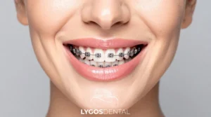Yenibosna Braces Cost