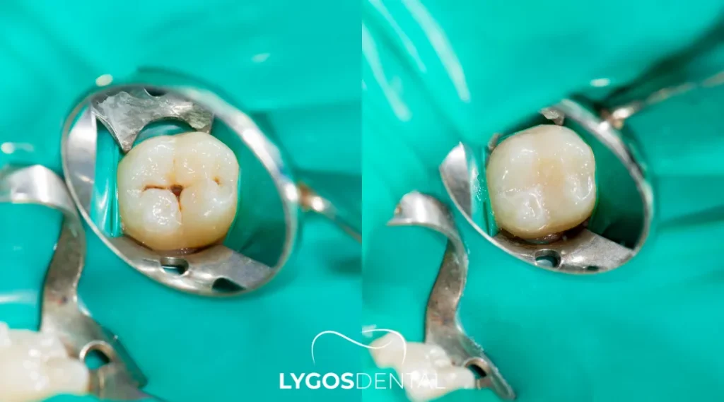 Yenibosna Diş Dolgusu: Süreç, Çeşitler ve Bakım