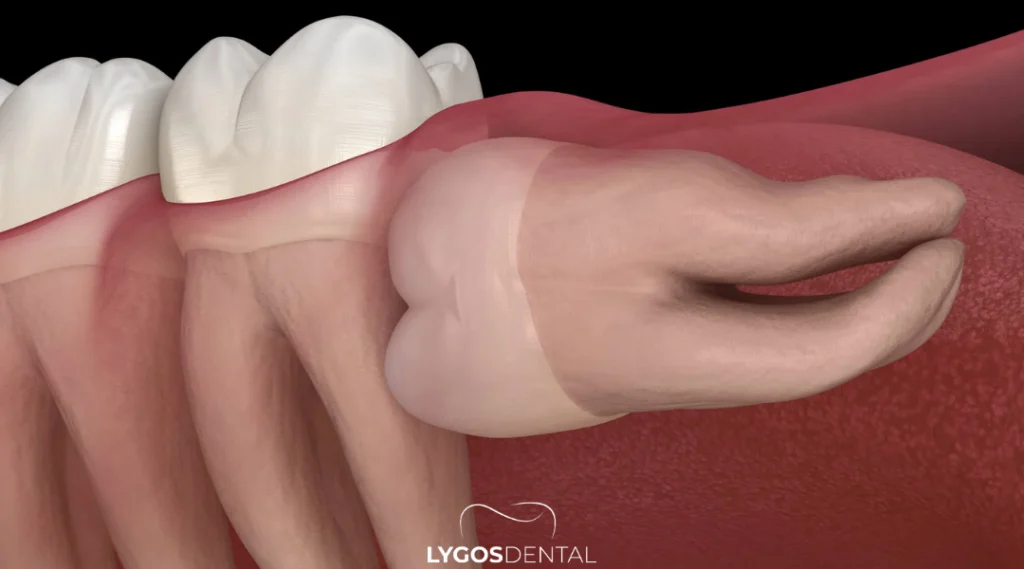 Özelde Diş Çekimi Fiyatı Ne Kadar? 1 Özelde Diş Çekimi Fiyatı Ne Kadar?