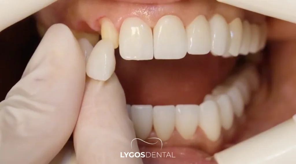 How Zirconium Compares to Other Crown Options