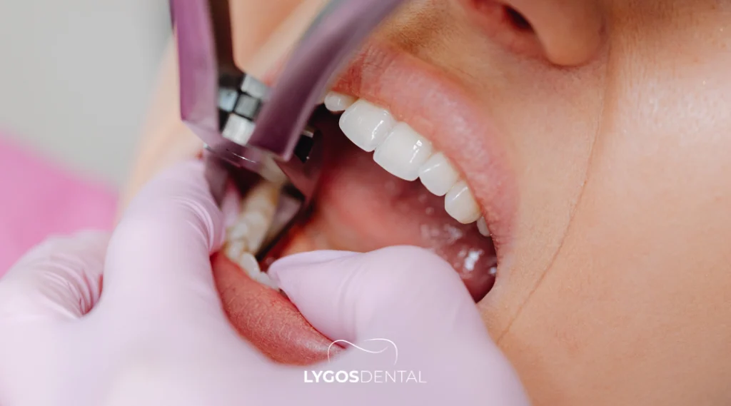 Extracția dentară în Bakırköy: la ce să vă așteptați