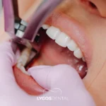 Tooth Extraction in Bakırköy: What to Expect