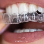 Clear Aligner Treatment in Izmir: A Comprehensive Guide