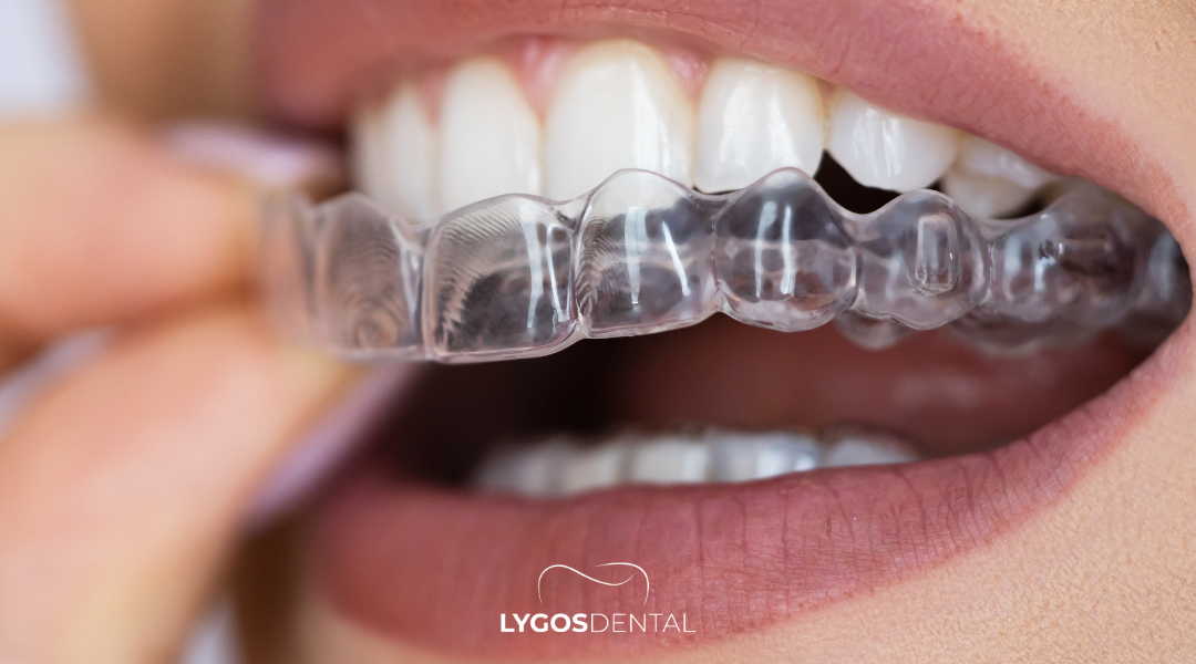 Clear Aligner Treatment in Izmir: A Comprehensive Guide