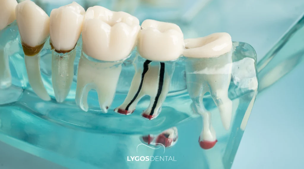 Istanbul Root Canal Treatment Prices Explained