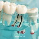 Istanbul Root Canal Treatment Prices Explained