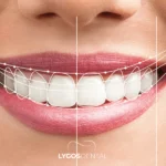 Izmir Smile Design: A Comprehensive Guide to Your New Smile