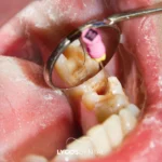 Root Canal Treatment in Izmir: A Comprehensive Guide