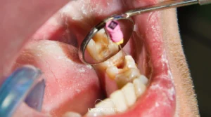 Root Canal Treatment in Izmir: A Comprehensive Guide 1 Root Canal Treatment in Izmir