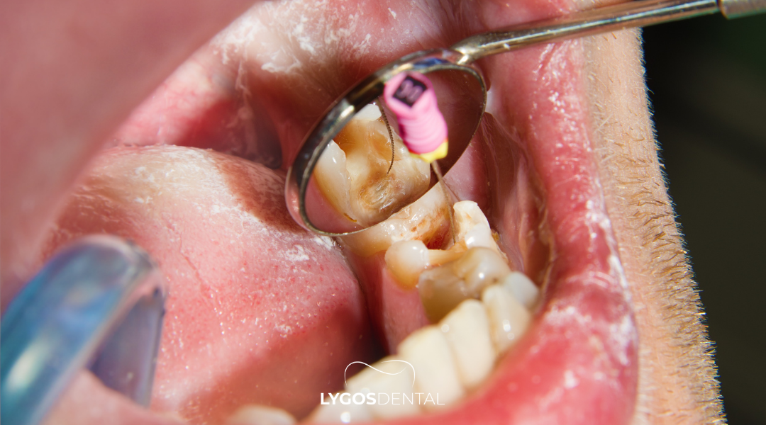Root Canal Treatment in Izmir: A Comprehensive Guide