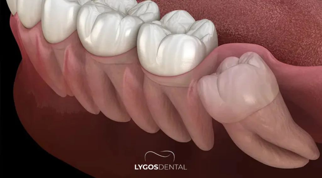 Understanding Why Wisdom Tooth Extraction is Necessary