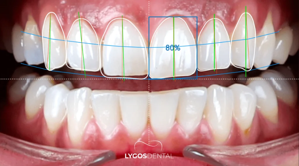 What Exactly Is An Izmir Smile Design