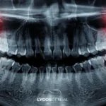 Wisdom Tooth Extraction in Izmir: A Complete Guide