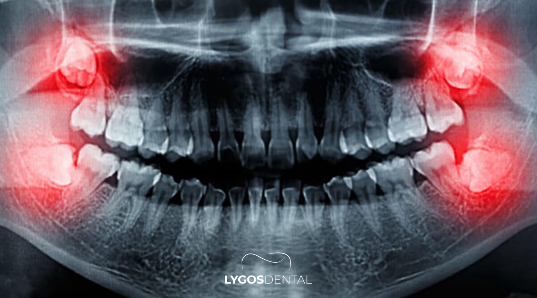 Wisdom Tooth Extraction in Izmir: A Complete Guide