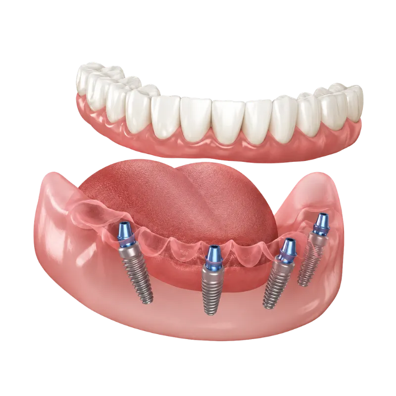 All-on-4 Full Arch