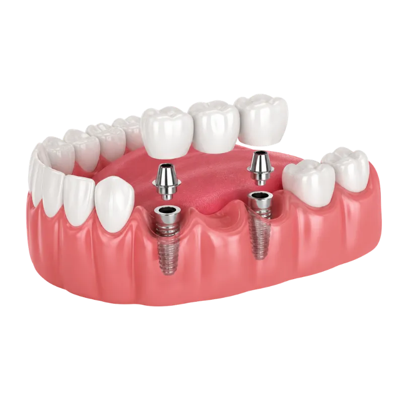 Implant-Supported Bridge