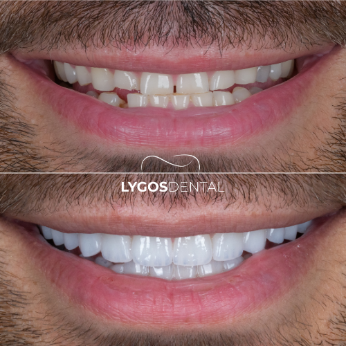 E-Max Veneers