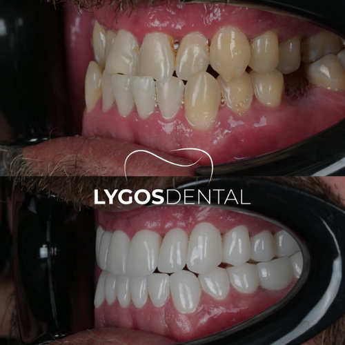 Zirconia Veneers