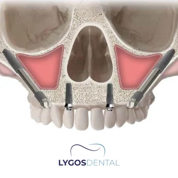 Advantages of Zygomatic Implants