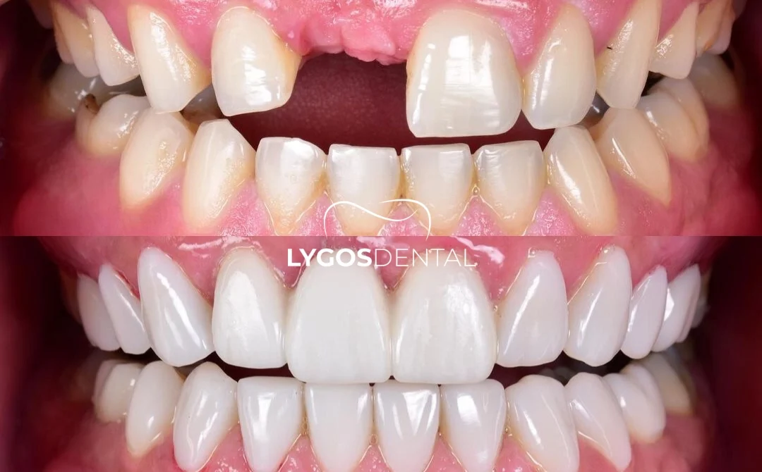 Single Tooth Implant Before and After