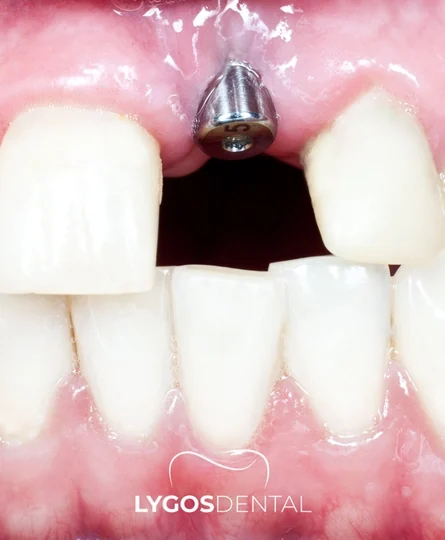 Single Tooth Implant HomePage