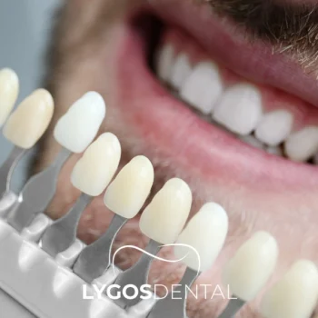 Types of Laminate Veneers